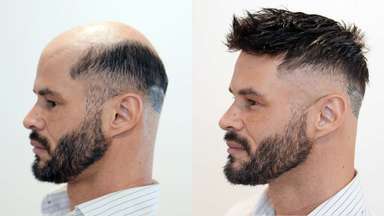 Mono Hair System - Industry-first design - Thicker density - Superior Durability - Extended Lifespan-image-2