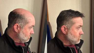 Hybrid Hair System - Multi-functional Design - Enhanced Airflow - Low Maintenance - (Recommended)		-image-2