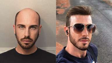Combo | Super Thin Skin Men's Hair Systems with Lace Front-image-5