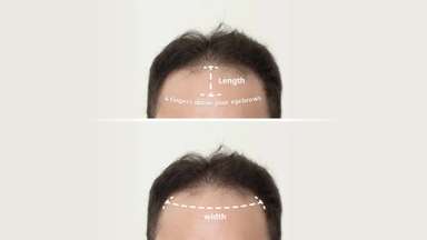 SuperSkin-F | Men's Frontal Hairpiece Made with a Super Thin Skin Base -image-4