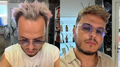 Hollywood Lace | Men’s Clip-On Hair System with French Lace and Thin Skin Perimeter-image-4