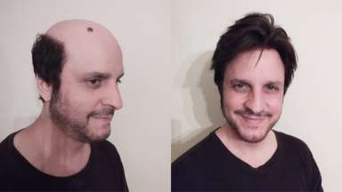 Inception-FL | Injected Thin Skin Toupee for Men Attached with French Lace and Diamond Lace-image-5
