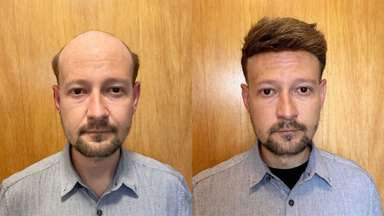Lite SuperSkin-V | 0.06mm Super Thin Skin 90% Light Density Hair System-image-8