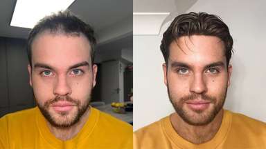 SuperSkin-F | Men's Frontal Hairpiece Made with a Super Thin Skin Base -image-8