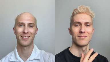 SuperSkin Premier | 0.08mm Premium hair Skin Men's hair system  -image-4