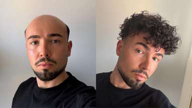 SuperSkin-V | 0.06mm Super Thin Skin V-looped Hair System - Best for New Users-image-9