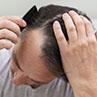 Hair Loss on Temples: Causes, Prevention, and Treatment Options