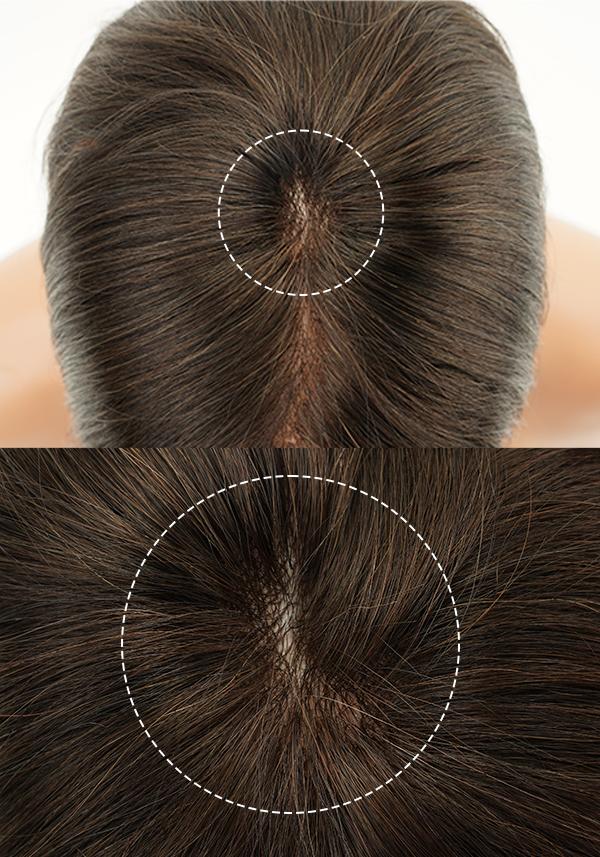 Hair System for Crown Hair Loss Men’s Hairpiece