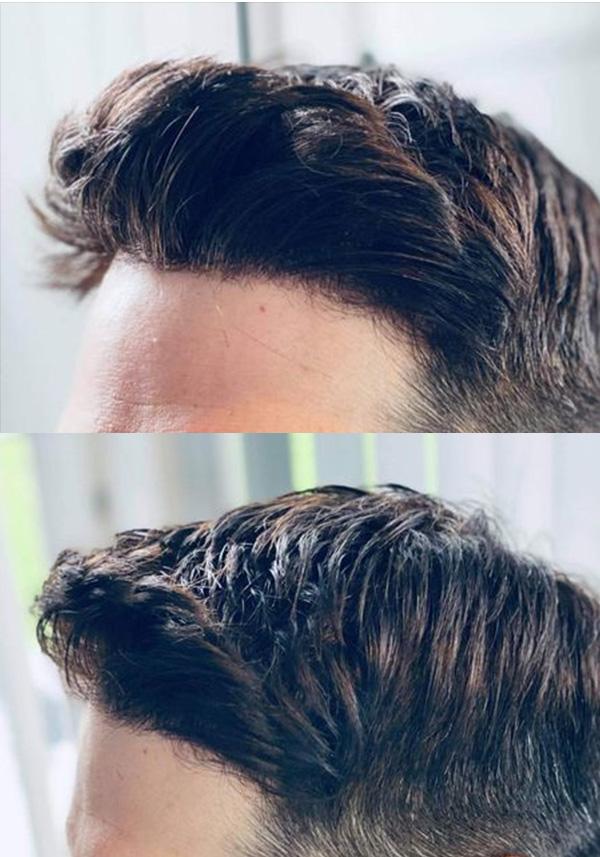 front hairline effect