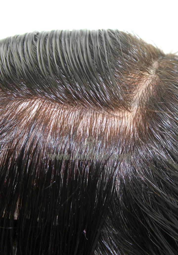 Injected Skin Hairpiece for Men