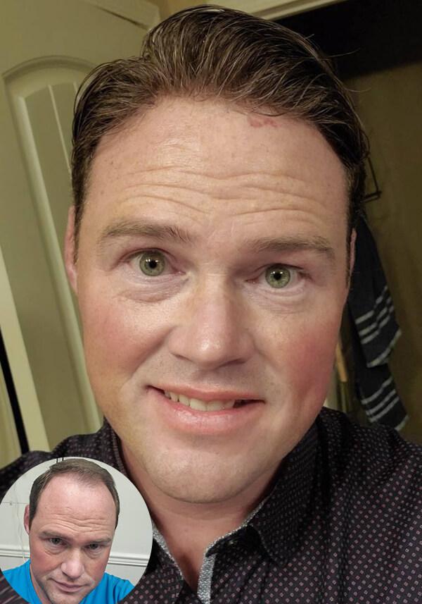 Inception-L Injected Thin Skin Toupee for Men