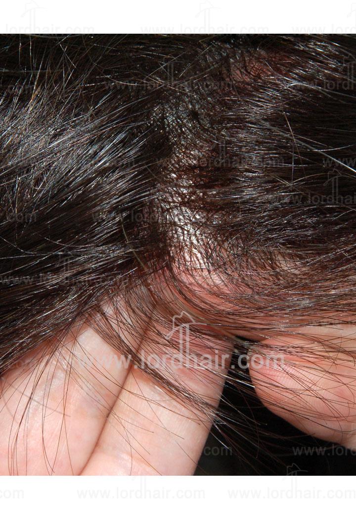 jq420hair replacement system