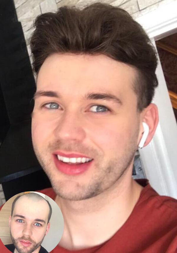 Neo Hair Replacement System for Men