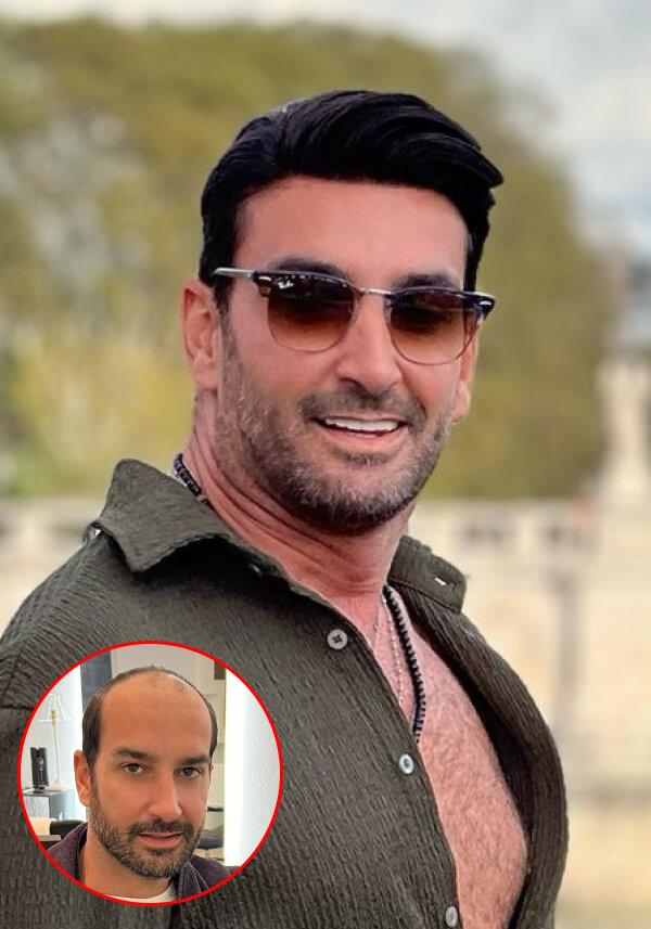 French Lace Top with 2 inches Skin Perimeter Hairpiece