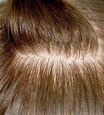 Silicon Skin Hair Replacement