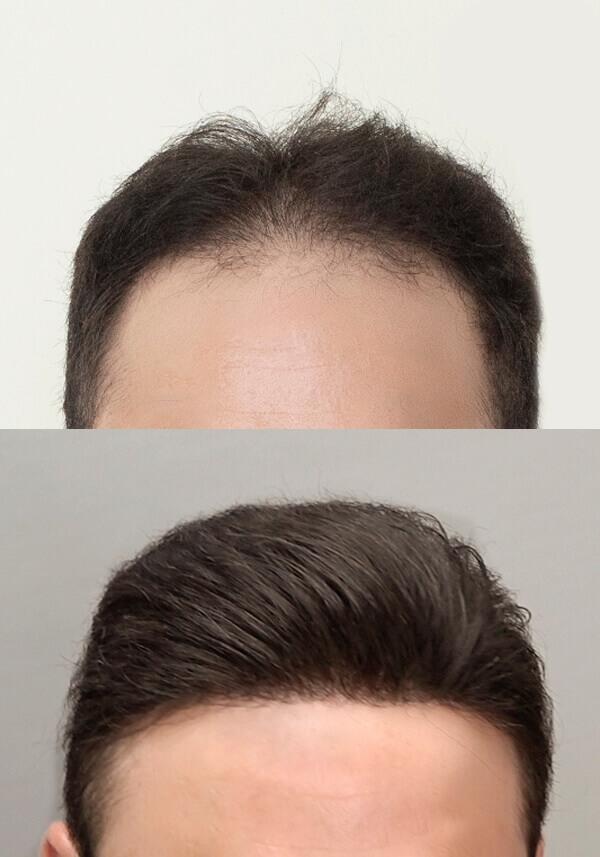 Frontal Hairpiece