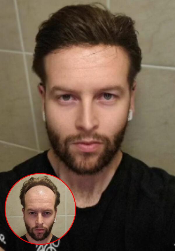 Frontal hairpiece for men