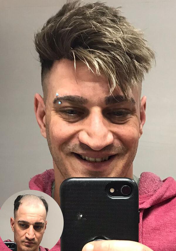 Men’s Thin Skin Hair System with 110% density