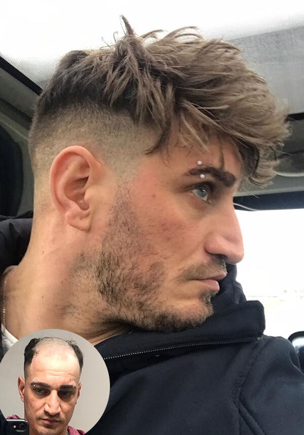 Men’s Thin Skin Hair System with 110% density