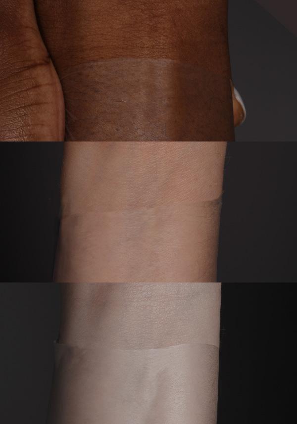 UTS-5-Ultra Thin Skin Hair System