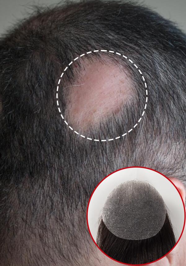 Side Patch | Patch Hair Loss Hair Patch for Men (2 Pieces)