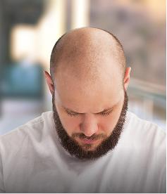 Genetic hair loss