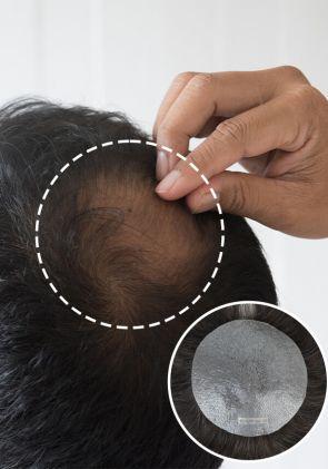 Crown Patch | Hair System for Crown Hair Loss Menโs Hairpiece