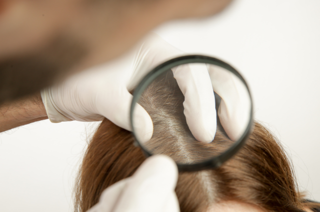 dry scalp hair loss