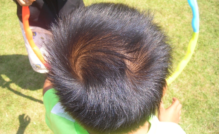 cowlick or balding