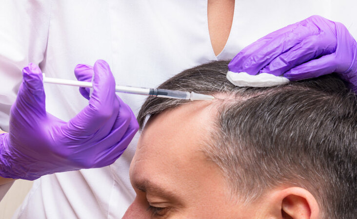 PRP Hair treatment