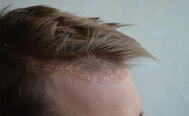 scalp psoriasis hair loss