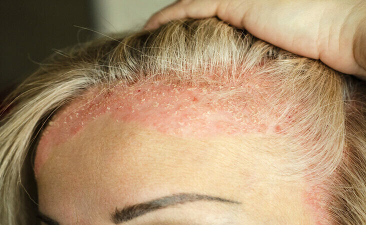 plica polonica treatment