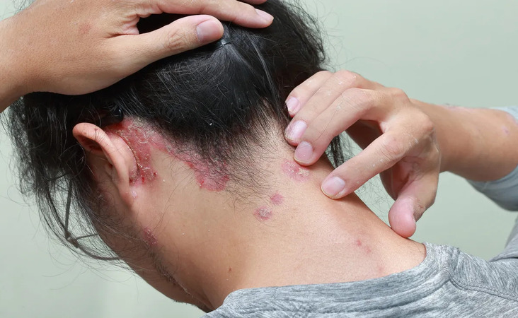 psoriasis and hair loss