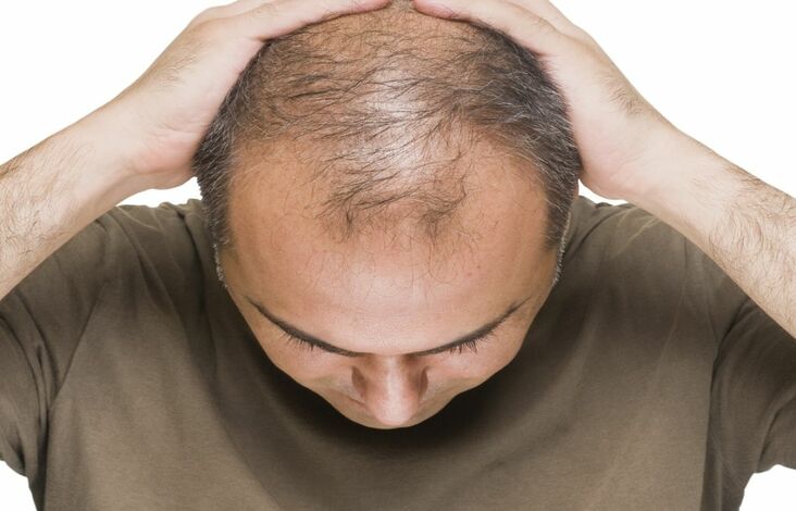 dht and hair loss