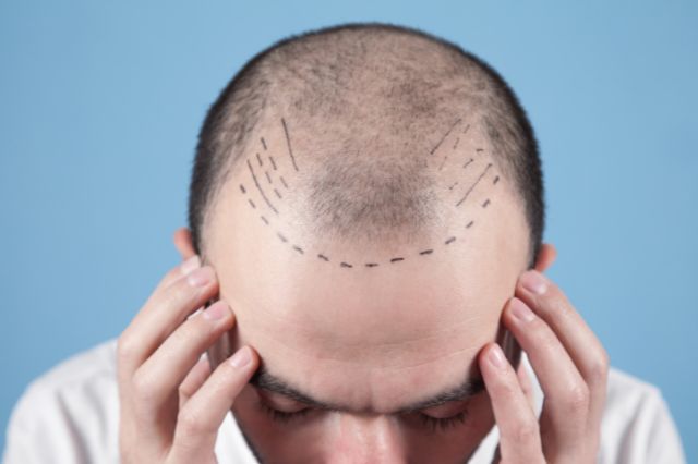 Litfulo hair loss