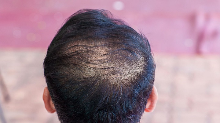 covid 19 hair loss