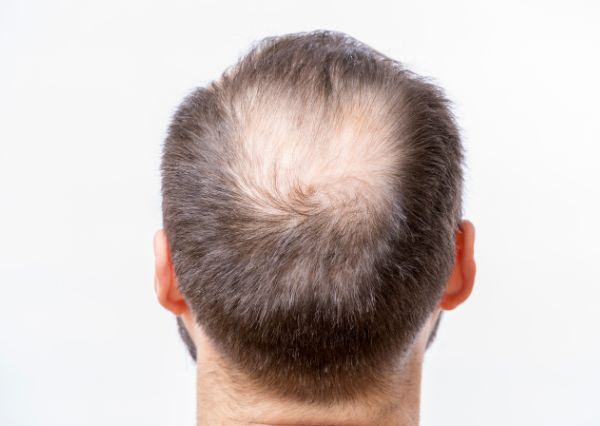 alopecia areata exclamation hair