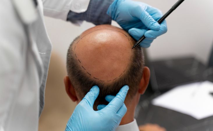 cost of hair transplant