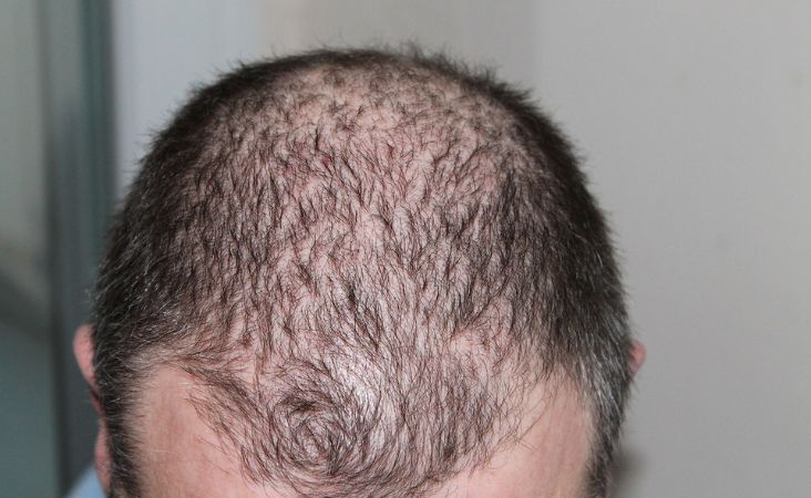 cost of hair transplant