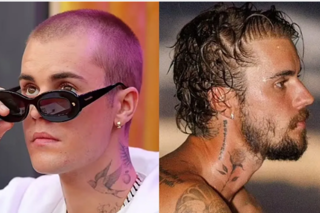 did justin bieber get a hair transplant 
