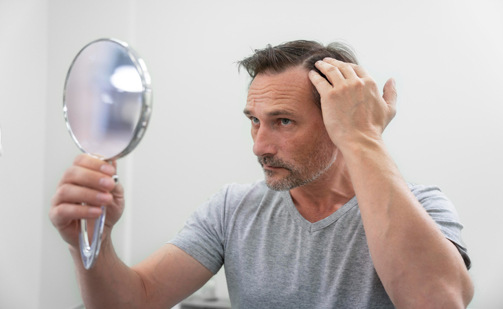 high cholesterol hair loss