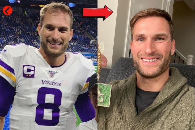 Kirk Cousins' hair transplant