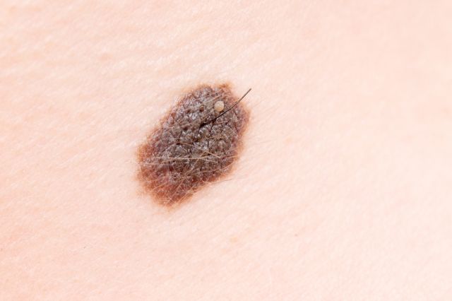 mole protein for hair recovery