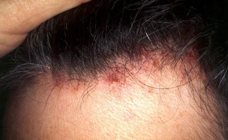 folliculitis hair loss