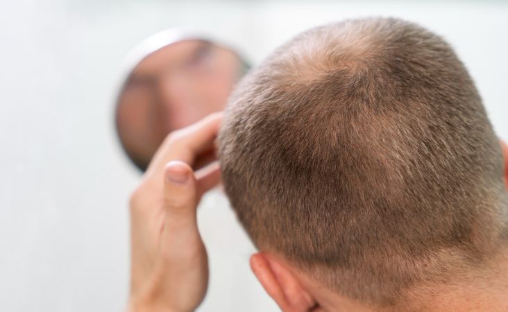 synthetic fiber hair transplant