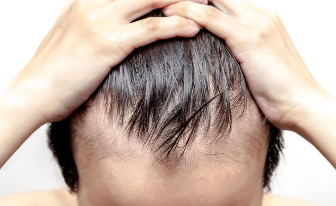 v shape baldness