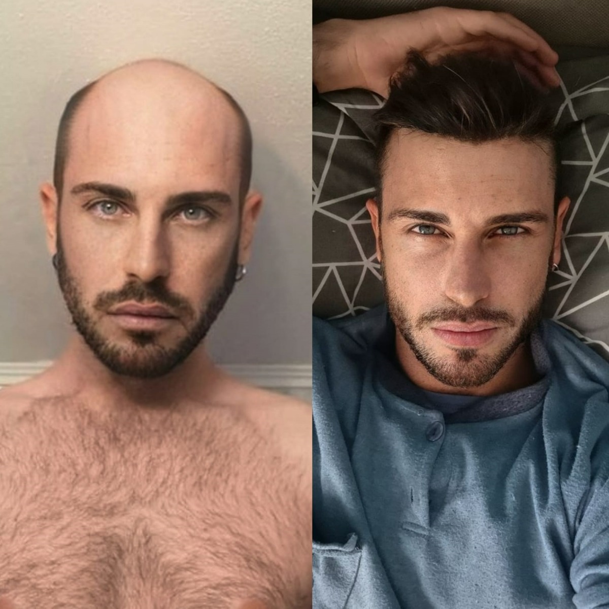 men's hair system transformation