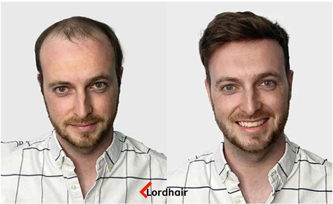 before & after vigor