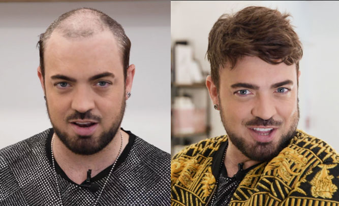 Aaron Lordhair hair system before and after