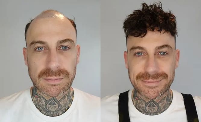 Champion lace hair system before and after